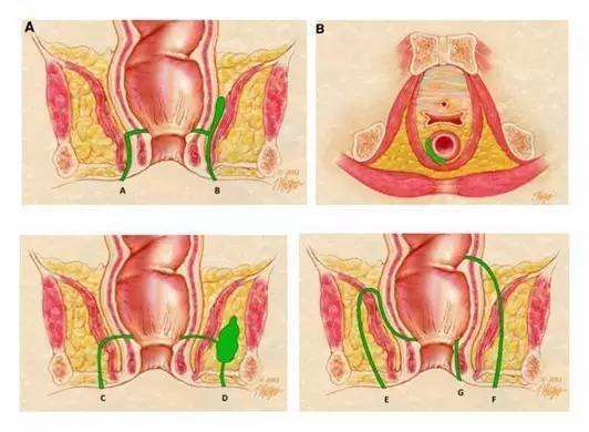 鑲涢棬鐤肩棝娴佽創鎬庝箞娌荤枟,鑲涢棬鍛ㄥ洿鐤肩棝娴佽創鎬庝箞娌荤枟