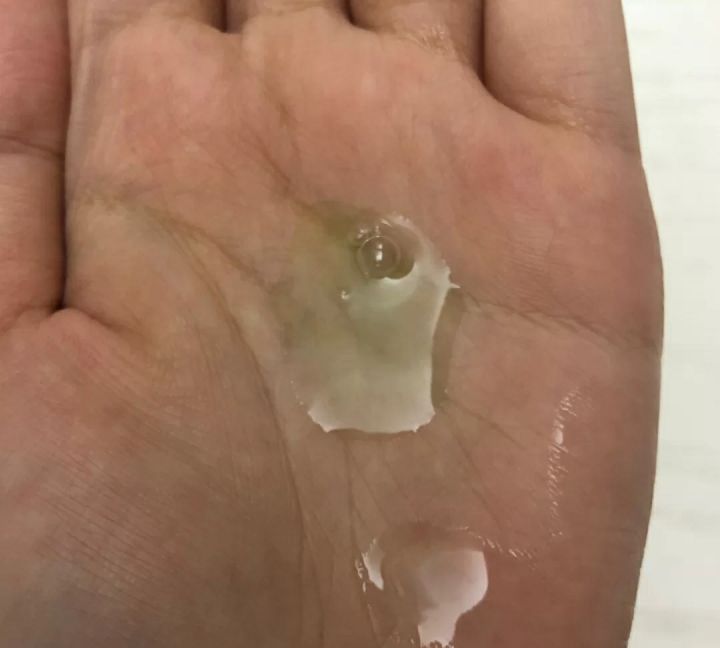 混油皮毛孔粗大怎么收缩毛孔,油皮毛孔大怎么护肤最好