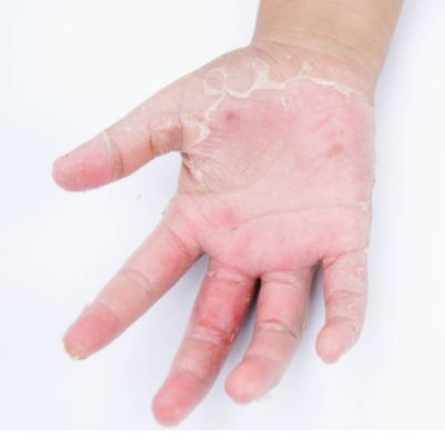 常见皮肤病的联合用药，呼吸道疾病的联合用药，值得收藏