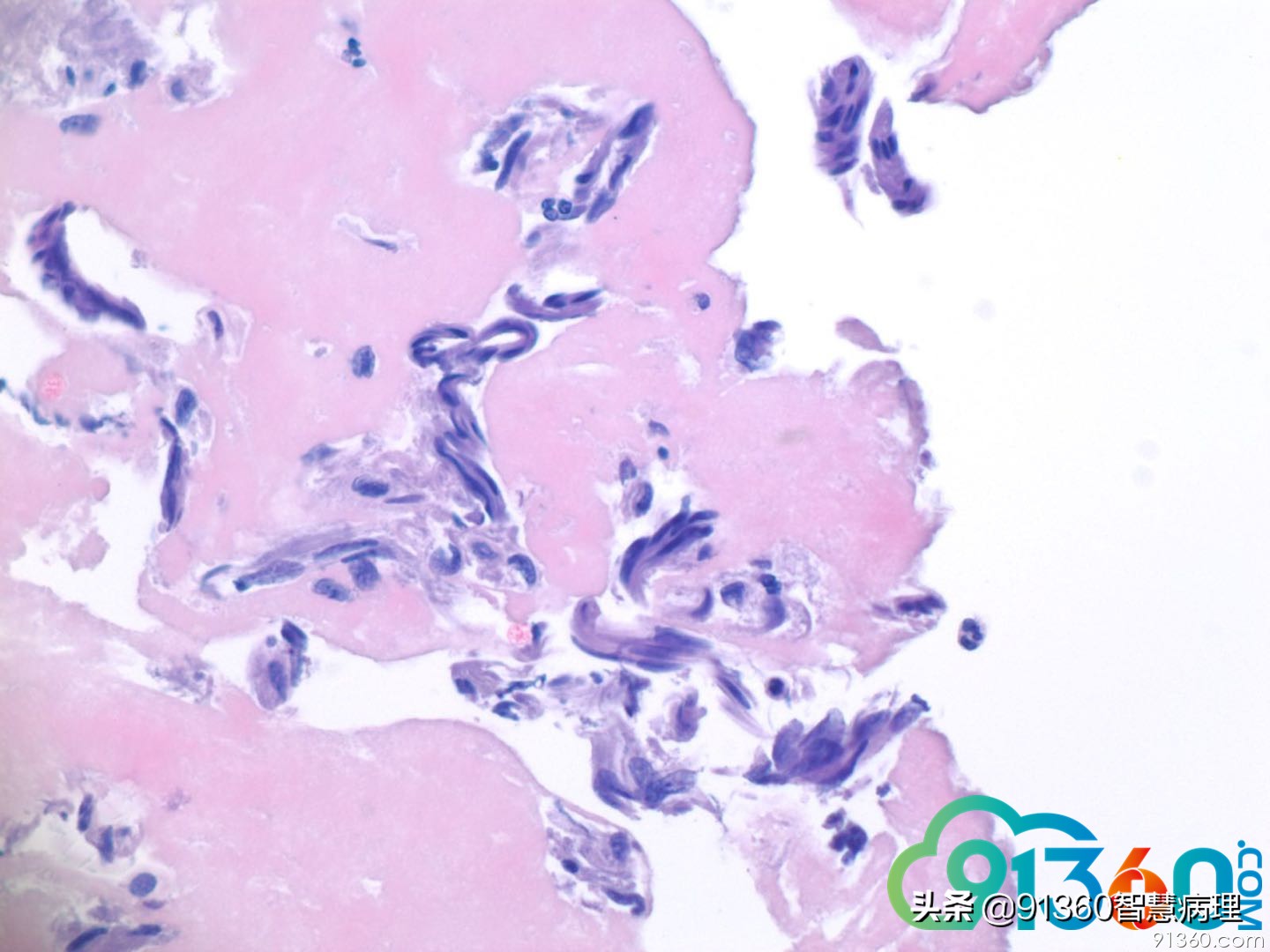 宫颈病理tct是什么检查,tct出现ascus会是宫颈癌吗