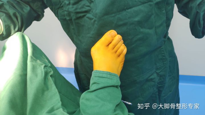 大脚骨判断标准,大脚骨自测方法