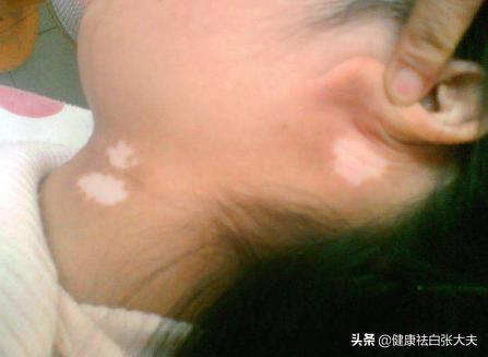 儿童湿疹引起白癜风能治好吗,湿疹后皮肤变白是白癜风吗