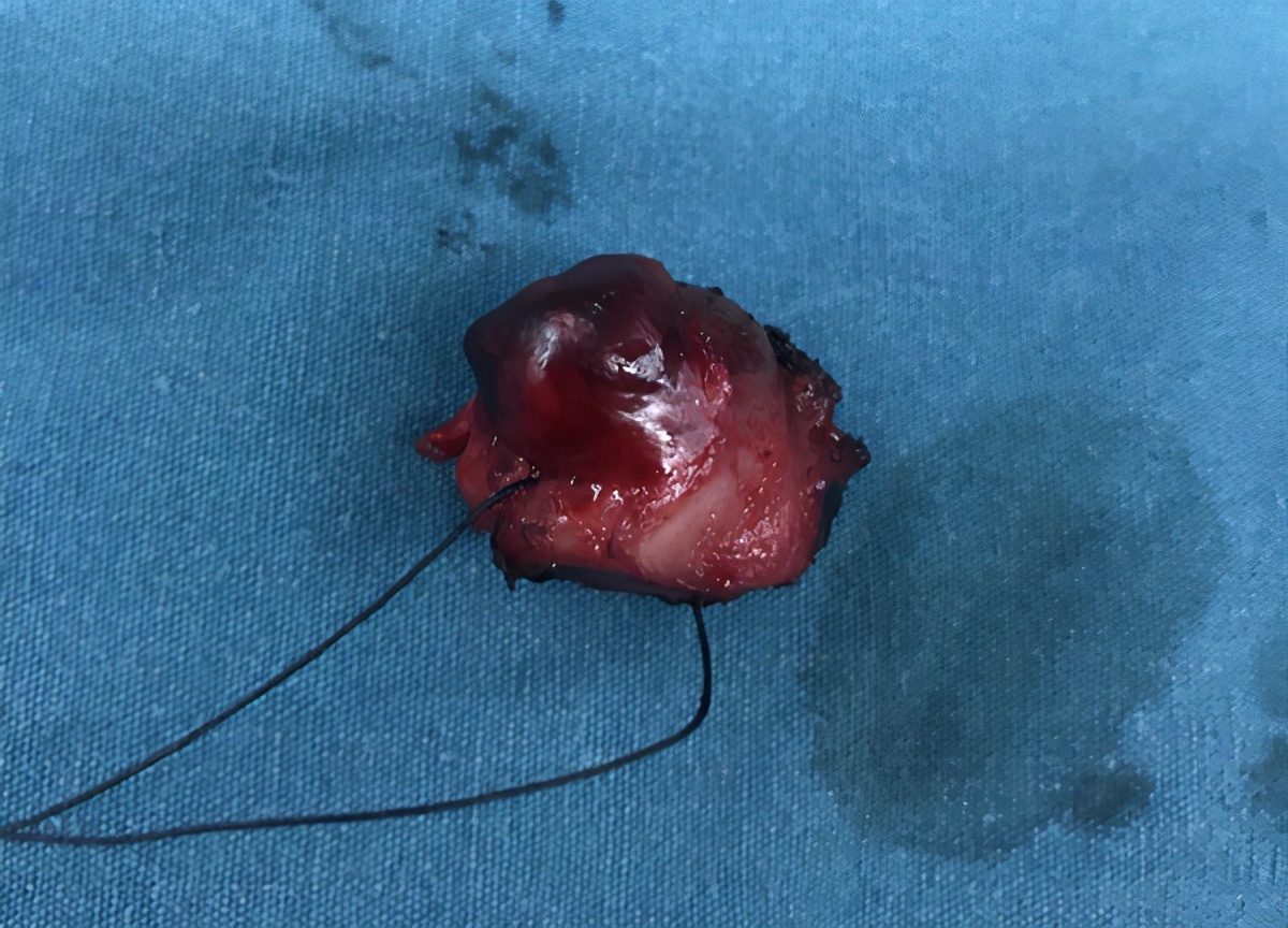 手术中的病理检查准确率高吗,手术病理