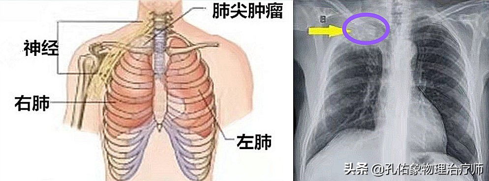 肩周炎肩膀疼痛用什么药,肩膀疼是肩周炎吗还是其他原因
