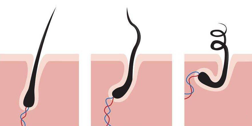 脱发后怎么判断毛囊是否萎缩,雄激素脱发的毛囊萎缩症状