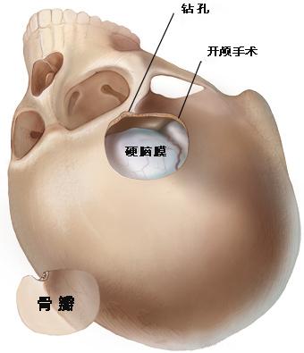 开颅手术的开颅是个什么样的操作,开颅手术最危险的是什么样情况