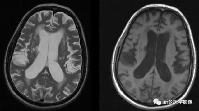 脑室为什么会扩张,脑室为什么会变小