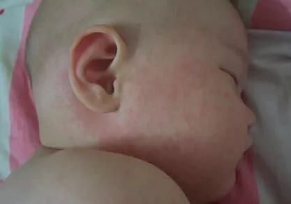 春天，宝宝皮疹的高发期！家长看看怎么辨别皮疹和护理！