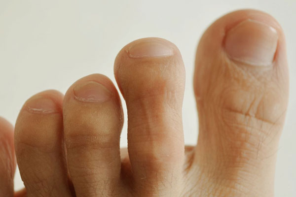 脚指甲往肉里长，走路还很疼？怎么办？