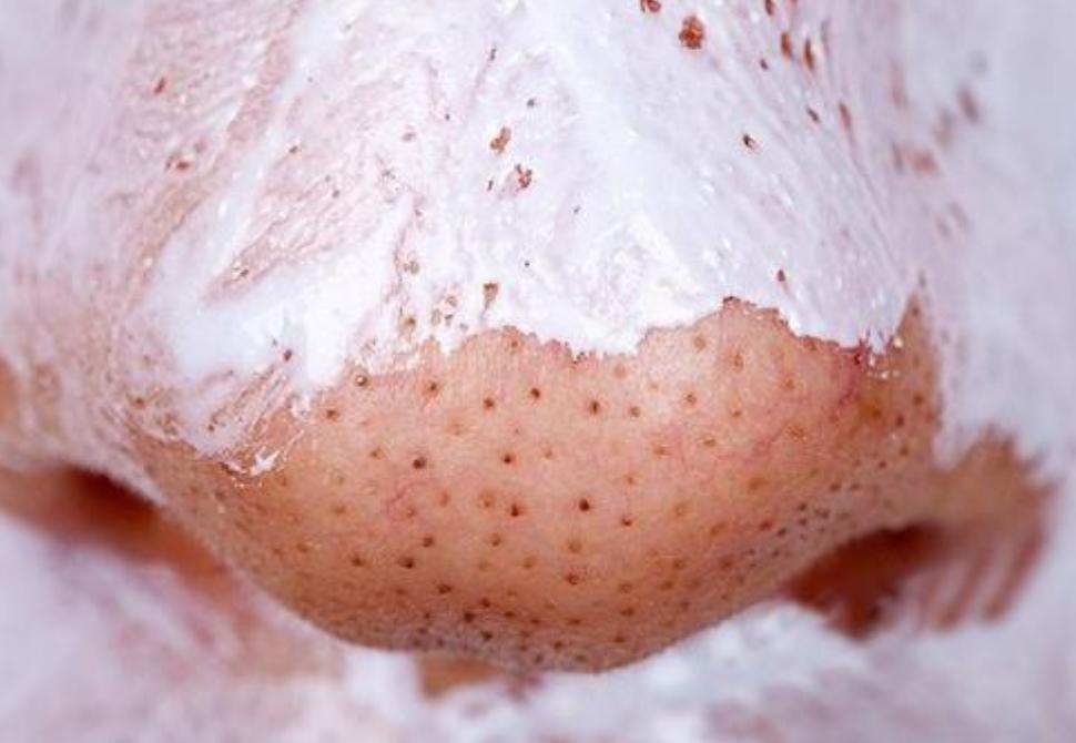 黑头如何能挤彻底,挤后背黑头起了大硬包怎么办