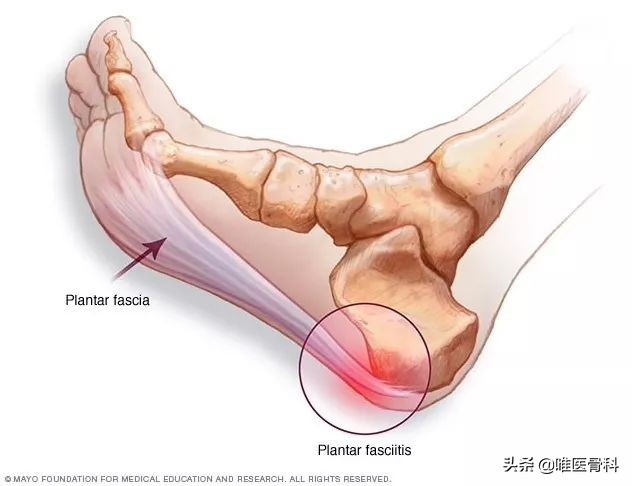 脚跟疼是足底筋膜炎么,足底筋膜炎是足底痛还是足跟痛