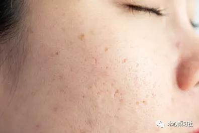 面部毛孔粗大有黑头在家怎么去除,面部暗黄毛孔粗大出油是什么原因