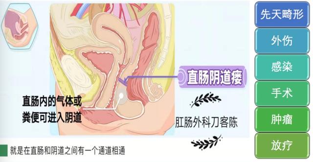 阴道直肠瘘有哪些症状,直肠阴道瘘有哪些症状