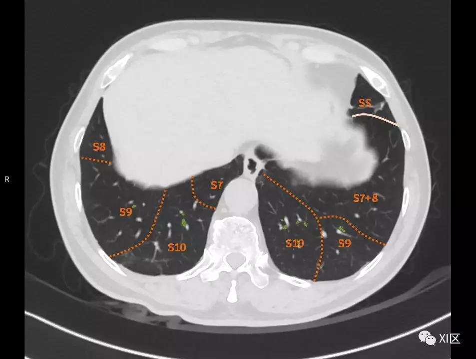 如此详细的肺部影像解剖，有点儿酷