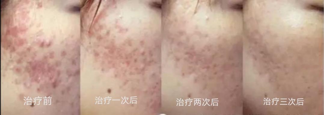 光子嫩肤的基本方法,光子嫩肤如何达到嫩肤效果