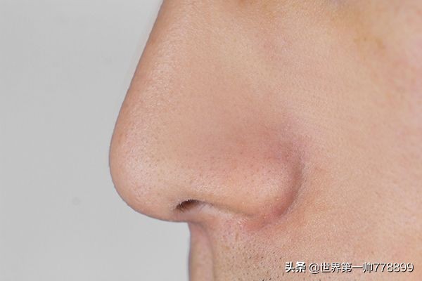 鼻子上挤出来的白色分泌物是什么,鼻子旁边挤出白色的分泌物是什么