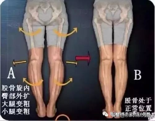 矫正O型腿的动作,o型腿矫正正确方法