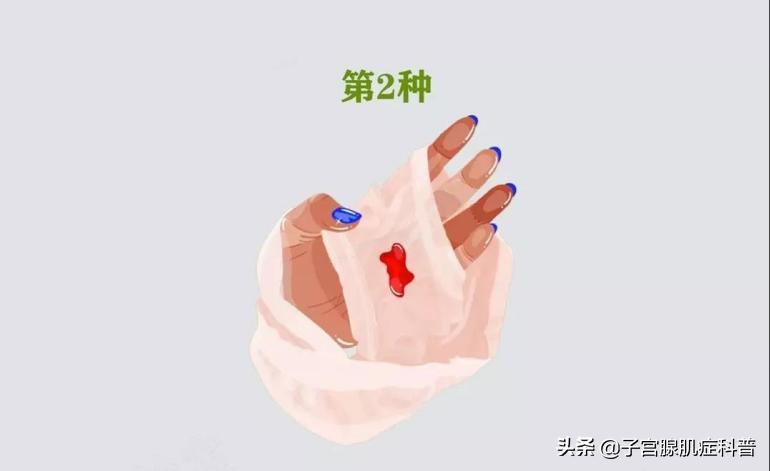 女士裤头有白带什么原因,女性裤头上带有褐色血渍什么原因