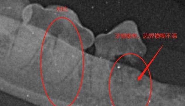 牙周疾病引起牙齿松动,牙周问题导致牙齿松动怎么办