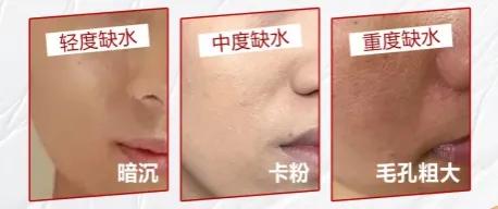 皮肤缺水的五大症状,皮肤出黄水很难好