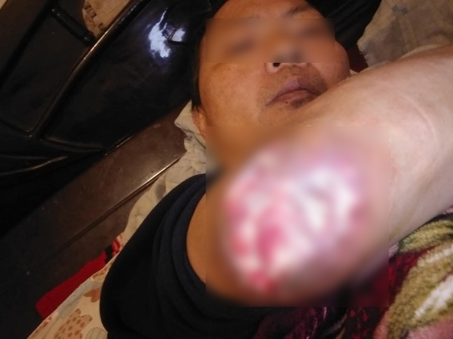 痛风石能挤碎吗,痛风石破溃后能自行愈合吗