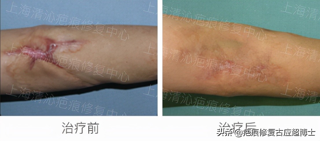 不忘初心，深耕疤痕难题！（匠心筑梦烙印天使）