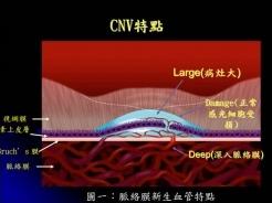 好消息关于医保,眼底病手术费进医保吗