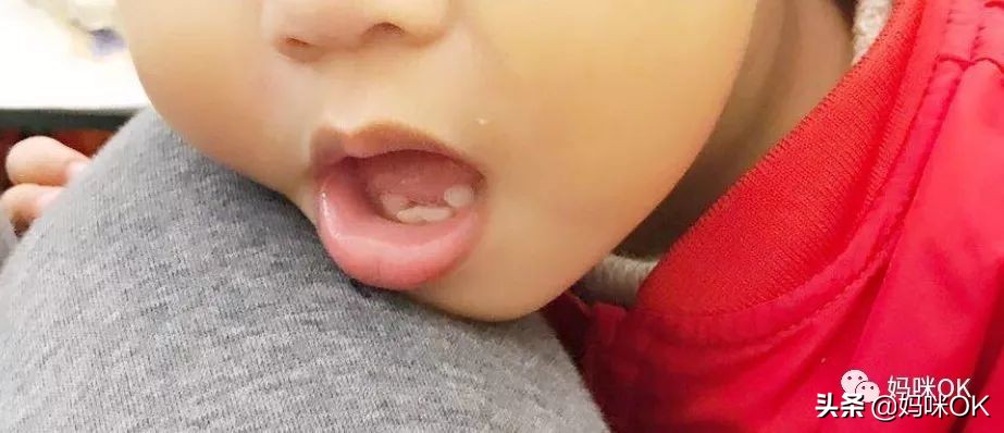 预防乳牙不齐的方法,牙不齐需要乳牙期干预么