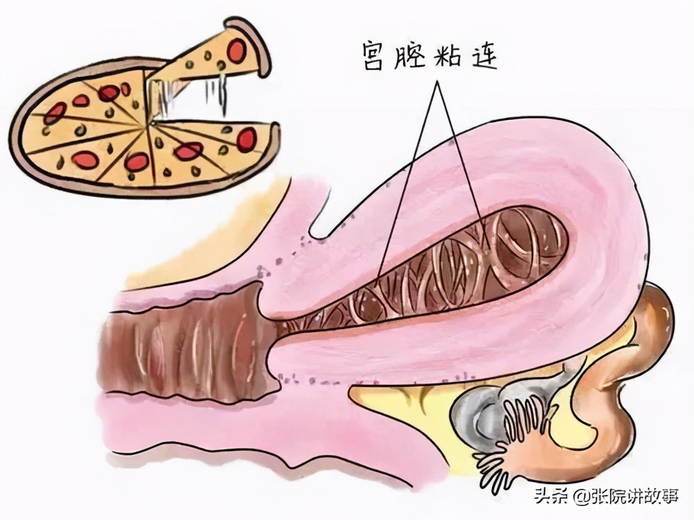 「张院讲故事」备孕妈妈心痛，医生头痛，宫腔粘连的危害这么大