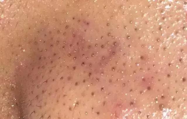 人人都会长黑头吗,好多人都长黑头吗