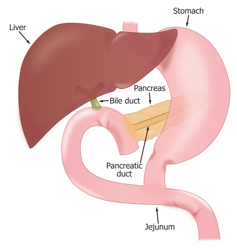 胆肠吻合术后胆瘘怎么处理,胆肠吻合口狭窄术后还会复发吗