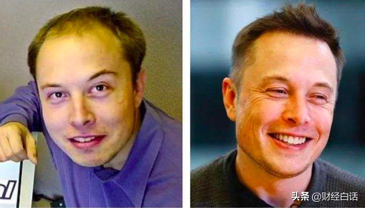 对抗秃头“钱景”大：富豪花30万植发，巨头力捧“生发药”