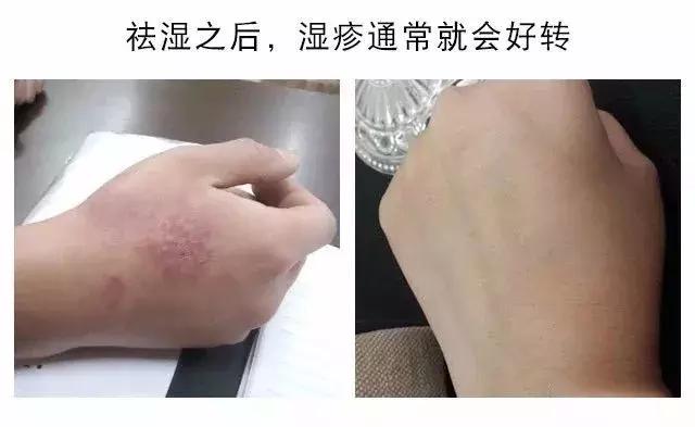 湿气寒气重的症状有哪些,男人湿气过重有哪些症状