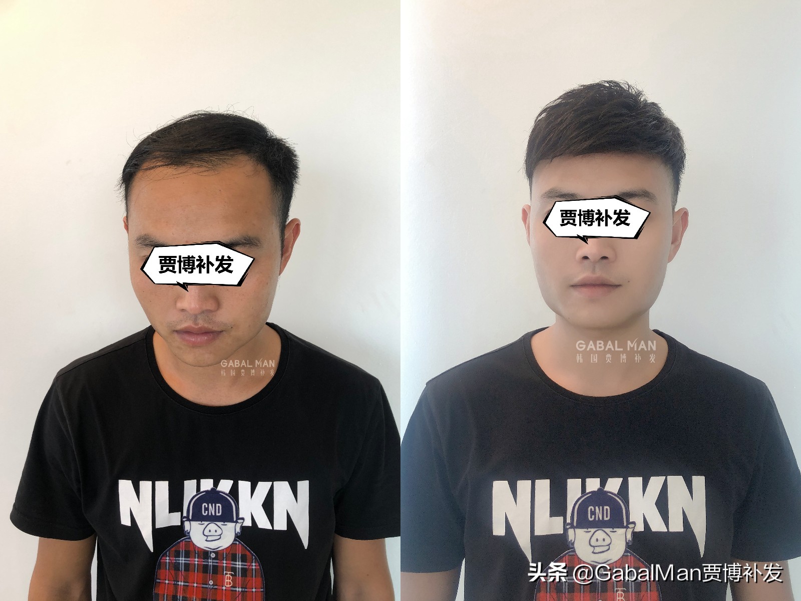 发际线极为危险,发际线有什么讲究