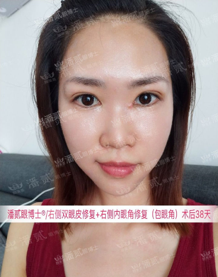 开眼角手术如何避免回缩,开眼角手术常见问题及解决方法