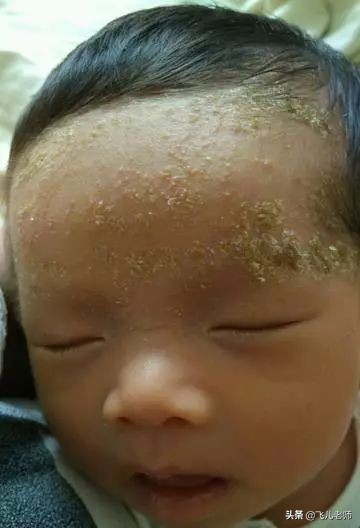 小孩长湿疹用什么方法最好,小孩起湿疹的最佳治疗办法