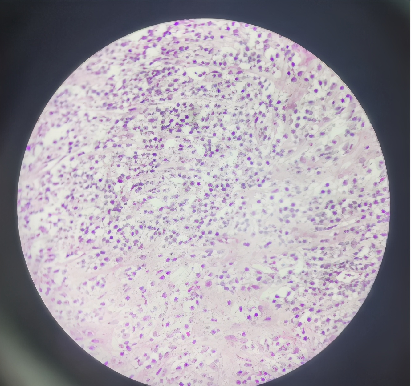 罕见肿瘤中医治疗案例视频,罕见肿瘤中医治疗案例