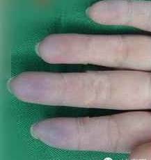 手掌什么颜色代表疾病及图片,手掌各个穴位的颜色反映什么疾病?