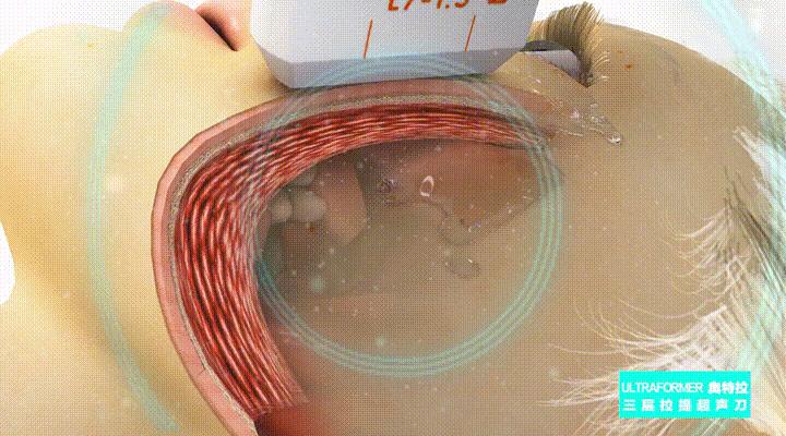 40岁-50岁上下，对抗面部松弛这些“弯路”请绕行？