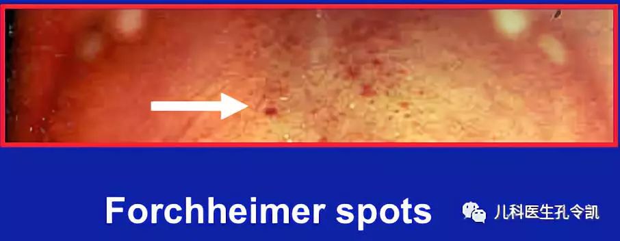 发热出红疹子可以吃过敏药吗,发热皮疹会反复么