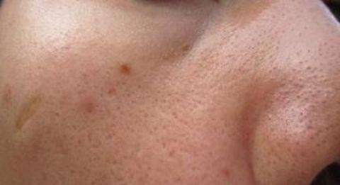 毛孔粗大怎么办教你一招,毛孔粗大怎么办护肤步骤