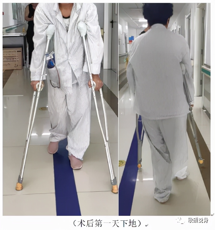 股骨头置换术后切口愈合,股骨头坏死置换第二次手术全过程