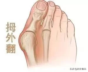 女人的烦恼大全,女朋友有拇外翻怎么办