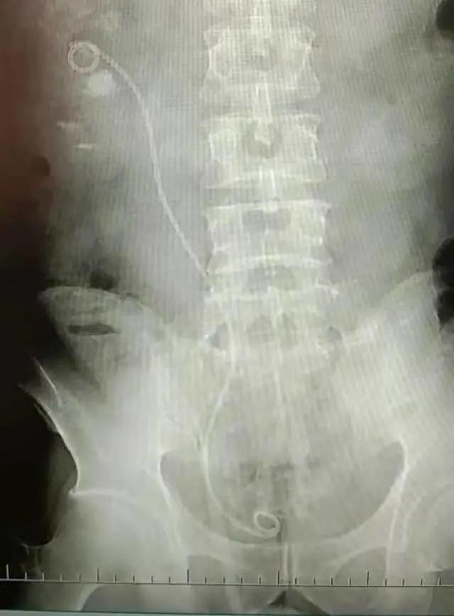 输尿管软镜碎石术安全么,输尿管软镜碎石术难受吗