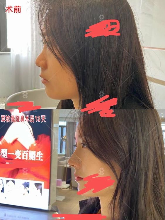 一次隆鼻手术一般几个切口,山根低鼻梁塌鼻翼大怎么隆鼻