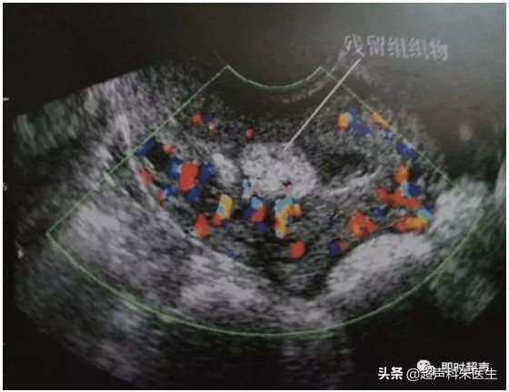 妇科超声的标准超声图,妇科超声图解