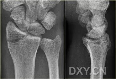 特殊骨折类型,特殊骨折体征