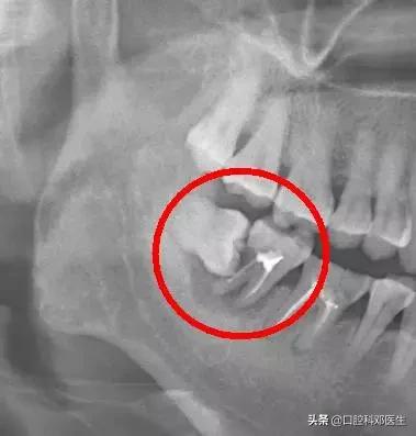 智齿很小一个自己就拔掉了,稍微晃动的智齿拔掉很快吗