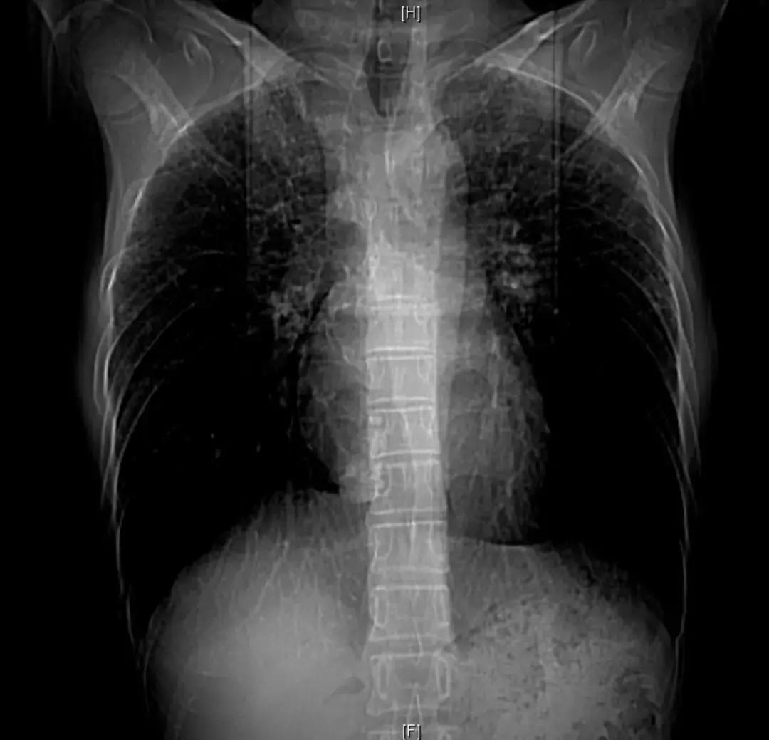 肺纤维化病例,肺纤维化手指甲发紫还能活多久