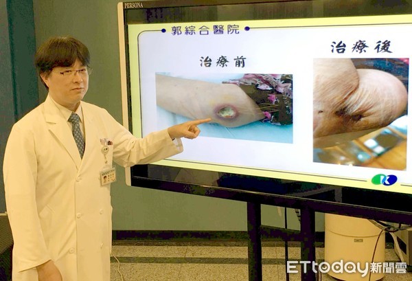 夭寿！伤口好不了又一直流脓　原来是它在作祟